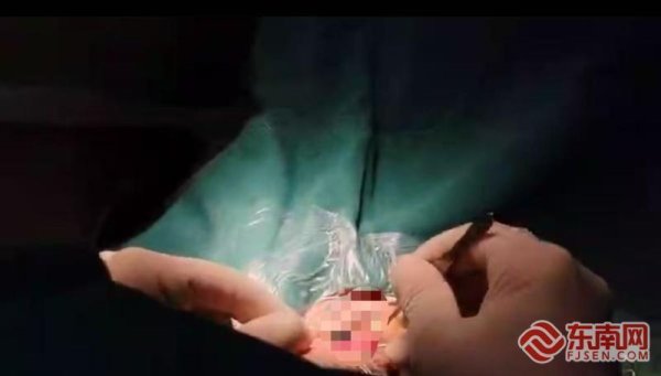 信富网 闽东医院成功救治视网膜脱离患者 40分钟手术助视力恢复